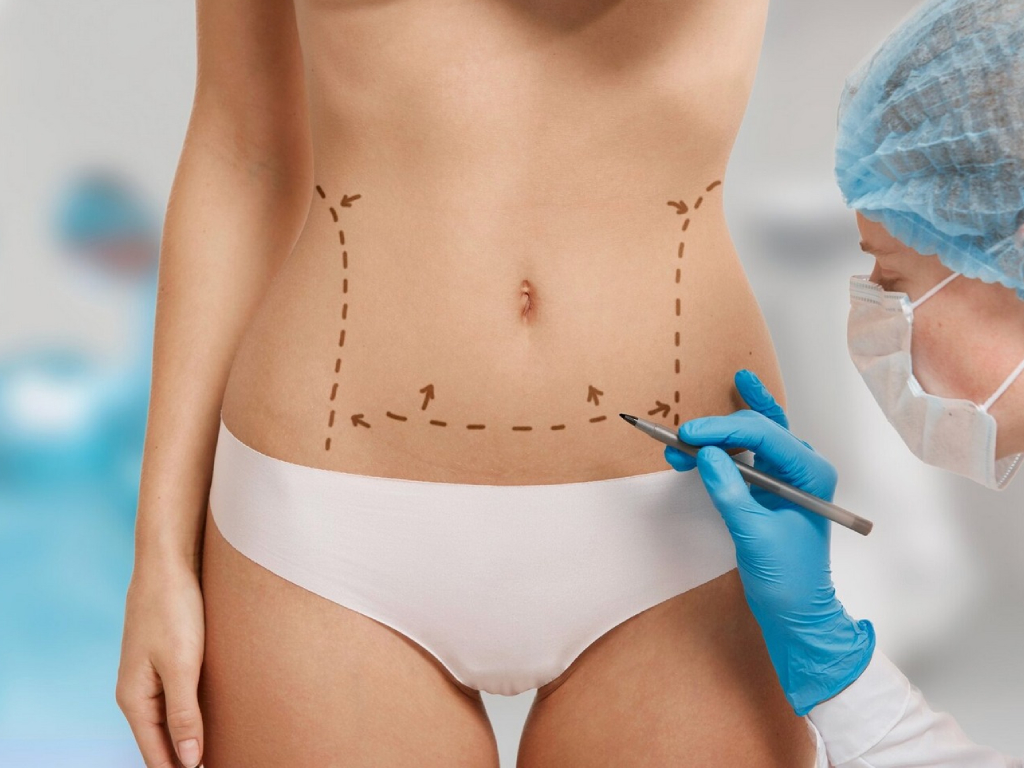 Abdominoplasty